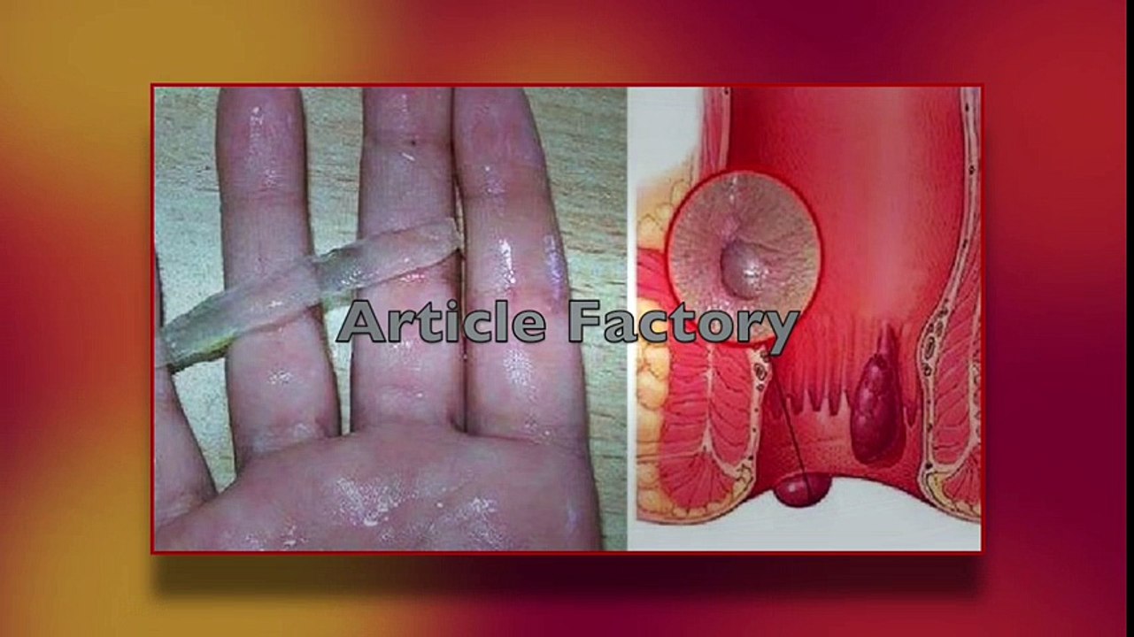 THIS IS THE BEST NATURAL CURE FOR HEMORRHOIDS! EVEN THE DOCTORS ARE AMAZED! | Hemorrhoid Treatment