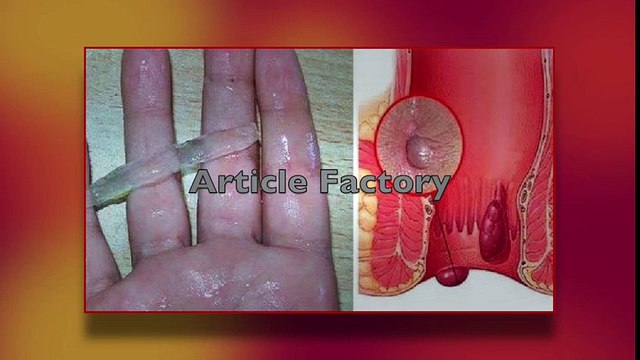 THIS IS THE BEST NATURAL CURE FOR HEMORRHOIDS! EVEN THE DOCTORS ARE AMAZED! | Hemorrhoid Treatment