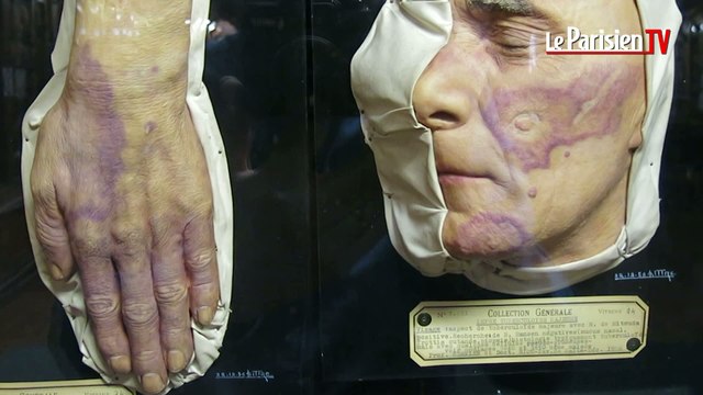 Mycoses, verrues, lupus: découvrez le musée des moulages dermatologiques