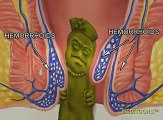 What Causes Hemorrhoids? Treatment and Cure.   Meditoons™ | Hemorrhoid Treatment