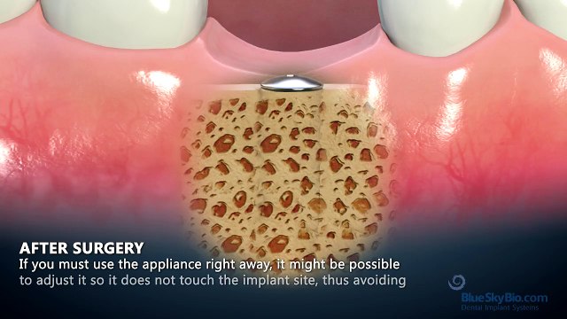 How do dental implants work-nha khoa Thuan Kieu