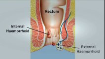 How To Cures For Hemorrhoids? ^ How To Cure External Hemorrhoids Without Surgery? | Hemorrhoid Treatment