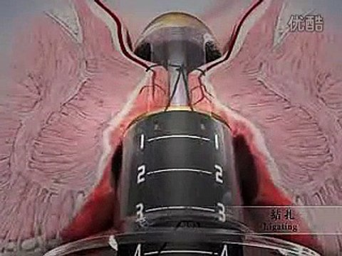 Stapled Hemorrhoidectomy or Minimally Invasive Procedure for Hemorrhoids | Hemorrhoid Treatment