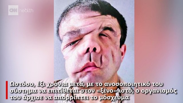 Ένας άνθρωπος, τρία πρόσωπα: Ο Ζερόμ Αμόν έγινε ο πρώτος άνθρωπος με δύο μεταμοσχεύσεις προσώπου