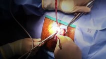 Hemorrhoids  Surgical Removal With Harmonic Scalpel | Hemorrhoid Treatment