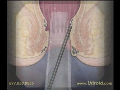 Ultroid the Painless Hemorrhoid Treatment 877-858-0555