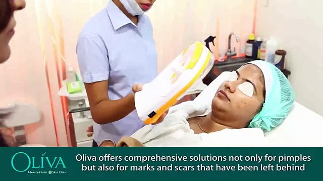 Treatment Pimples   Acne Treatment in Bangalore   Pimples Treatment in Bangalore