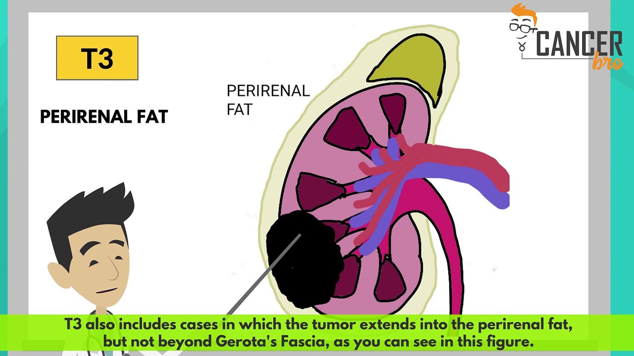CancerBro explains kidney cancer staging