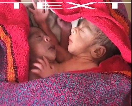 Miracle Baby born with 2 heads, 4 arms and 2 legs, in India