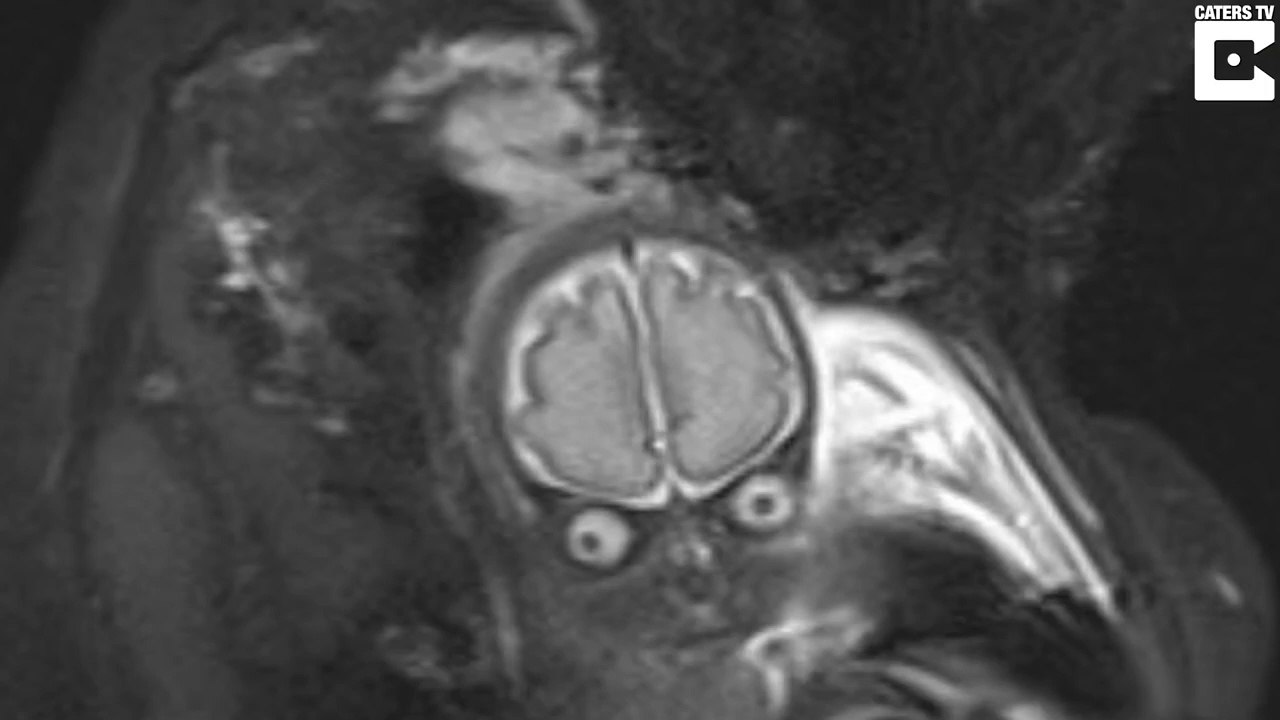 Elle fait faire une IRM du cerveau à son bébé et va avoir la peur de sa vie