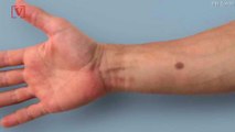 Skin Implant Creates Mole-Like Tattoo that Could Detect Cancer