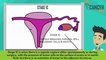 Ovarian cancer staging explained by CancerBro