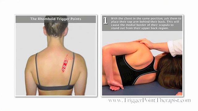 The Rhomboid Trigger Points (Free Full Video)