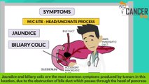 Pancreas cancer symptoms explained by CancerBro