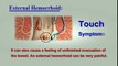 Hemorrhoids Symptoms – Top 10 Signs between External Hemorrhoids and Internal Hemorrhoids | Hemorrhoid Treatment