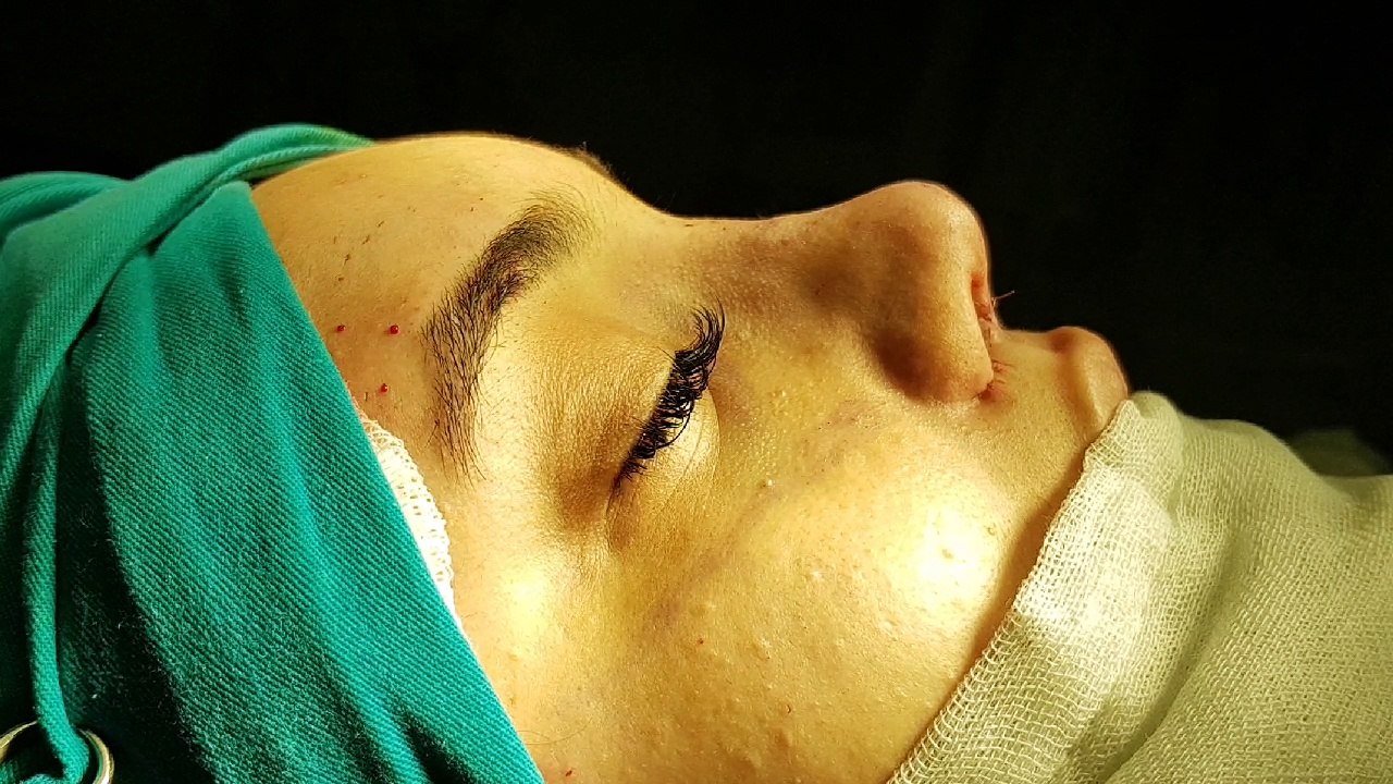 Op Dr Mustafa Ali Yanık burun şikayet ve çözümleri ve hasta sonuçları