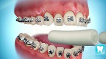 Process of Braces Placement. Orthodontist in Ahmedabad