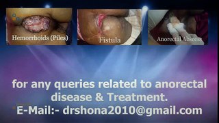 Hemorrhoids (Piles) and Fistula | Hemorrhoid Treatment