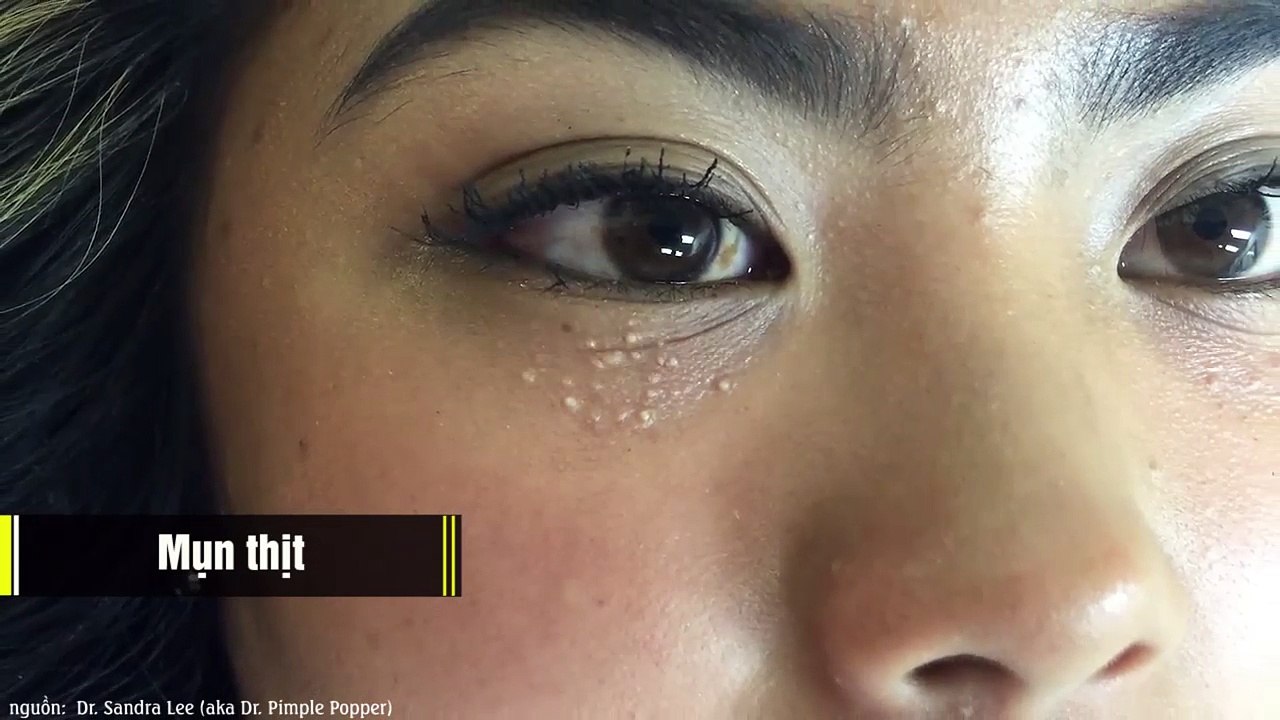 Những loại mụn trông “chướng mắt” nhưng tuyệt đối không nên nặn