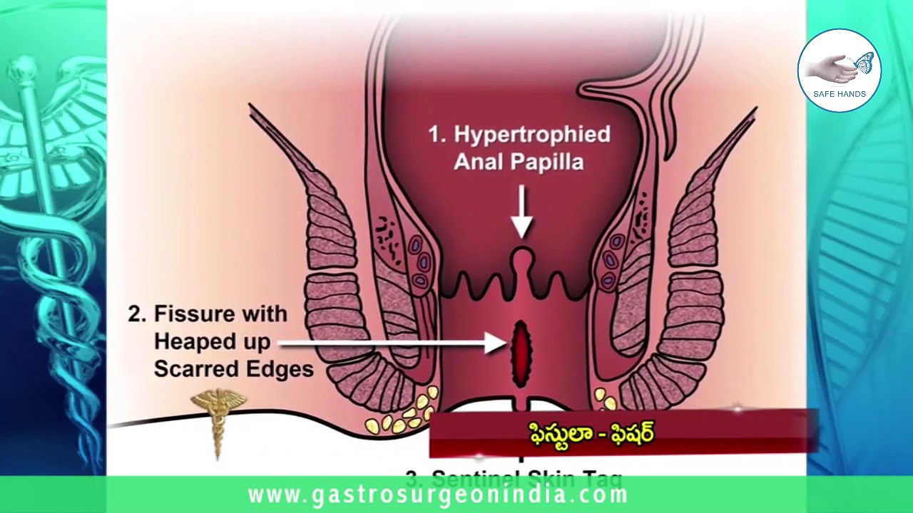 Anal Fissure and Fistula - Dr.G.Parthasarathy, Hyderabad | Fissure Surgery | Gastrosurgeon In India