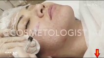 girl botox face botoks videos video / fille botox visage botoks vidéos