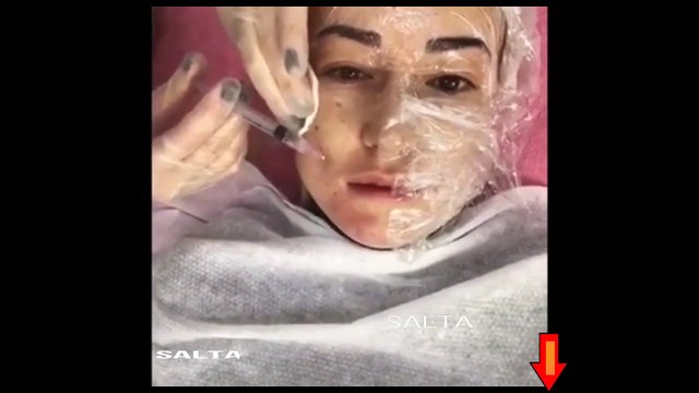 botox face botoks videos video girl / fille botox visage botoks vidéos