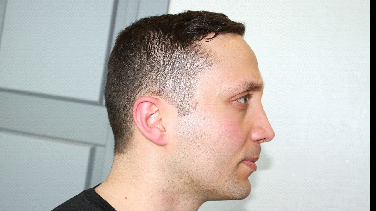 Mustafa Ali Yanık burun şikayet ve çözümleri ve hasta sonuçları