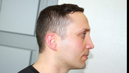 Mustafa Ali Yanık burun şikayet ve çözümleri ve hasta sonuçları