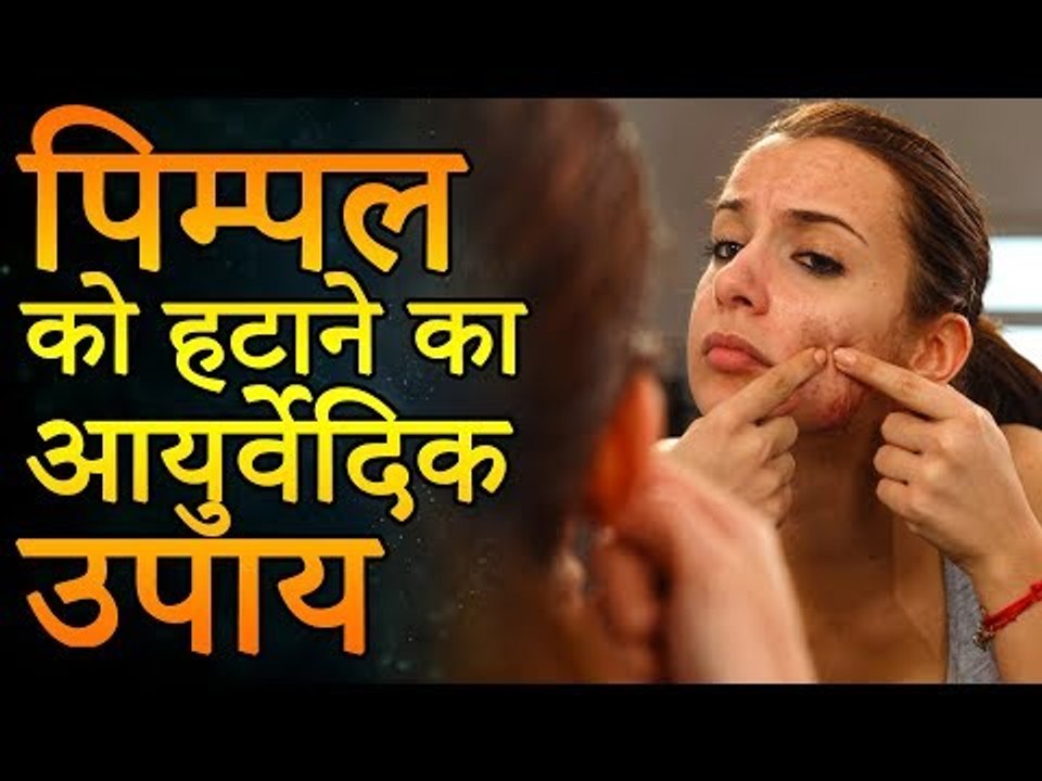 एक ही रात में पिम्पल्स कैसे हटाए | पिम्पल्स को हटाने के आयुर्वेदिक उपाय | Remedies for Pimples