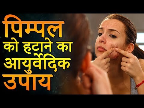 एक ही रात में पिम्पल्स कैसे हटाए | पिम्पल्स को हटाने के आयुर्वेदिक उपाय | Remedies for Pimples