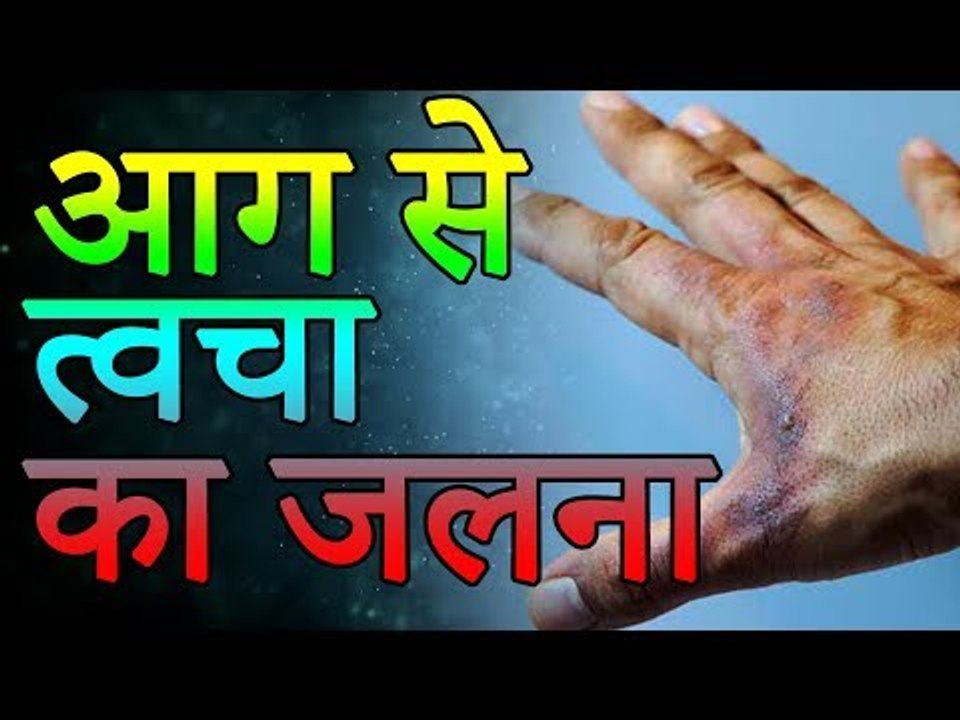जली हुई त्वचा के जलन अाैर दाग को खत्म करने के नुस्खे | Health Tips