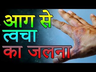 Burns Treatments Instantly | आग से जलने पर तुरंत करे ये घरेलू उपचार | Healthy Remedy