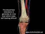 Patellar tendonitis or Jumper