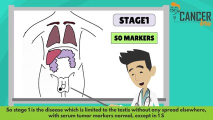 TNM testicular cancer staging