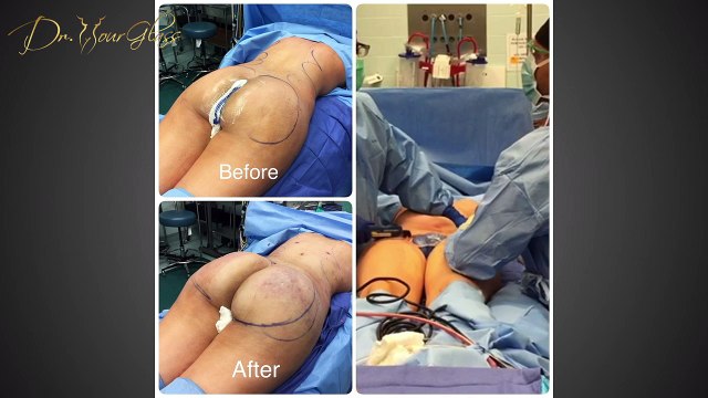 What happens during a brazilian butt lift surgery ?