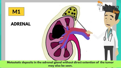 Metastatic kidney cancer treatment by stages