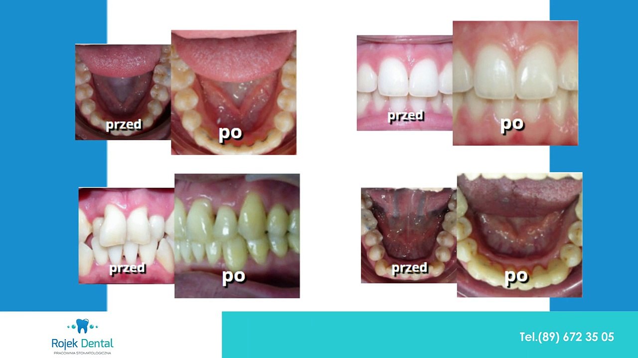 Ortodoncja leczenie stolatologiczne leczenie wad zgryzu Olsztyn Pracownia stomatologiczna Lek.dent. Klaudiusz Rojek