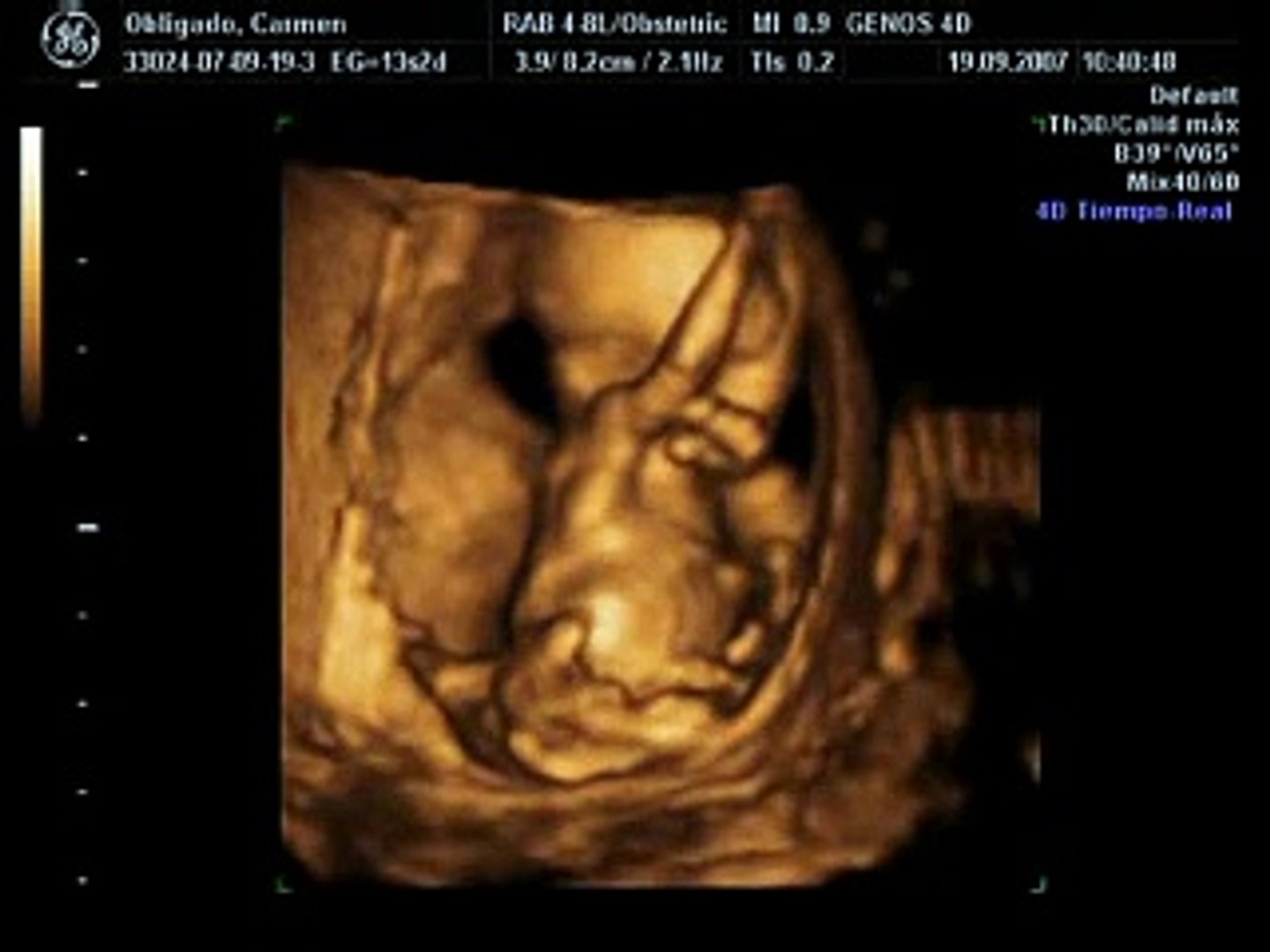 الموجات فوق الصوتية للحمل، الأسبوع الثالث عشر، فيديو الحركة اليومية