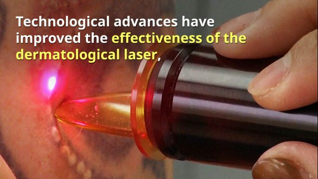 9 Things You Need To Know About Laser Tattoo Removal