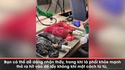 Shock khi xem cận cảnh lá phổi của người hút thuốc lá mỗi ngày suốt 20 năm