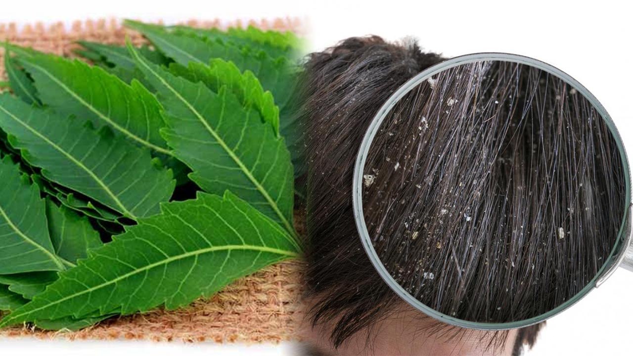 Neem Oil for Dandruff | नीम के तेल से इस तरह करें डैंड्रफ की समस्या दूर | Boldsky
