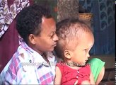 Indian Child's head suddenly starts growing, weighs 8 kilograms
