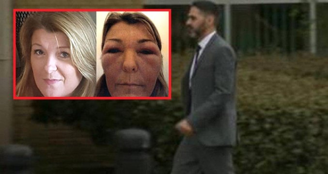 Sahte Türk Doktor İngiltere'yi Ayağa Kaldırdı! Botoks Yaptığı Kadınları Tanınmaz Hale Getirdi