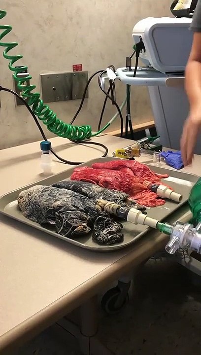 Une infirmière filme l’état des poumons d’un fumeur décédé à côté de poumons sains