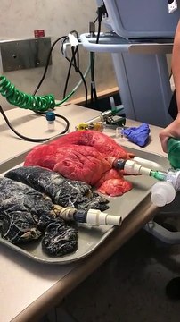 Poumons de fumeur vs Poumons sains