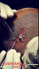 Best Hair Loss Treatment For Men