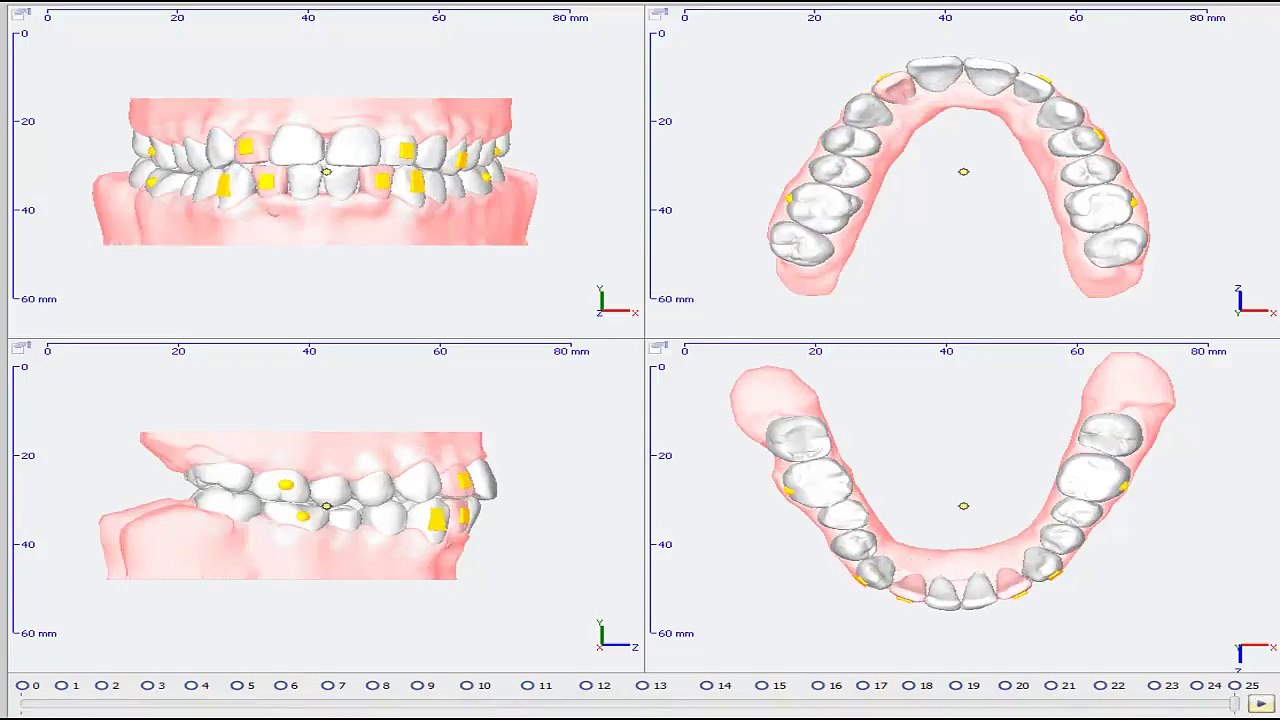 Clearfix Tedavi Simülasyonu - Dar Ark
