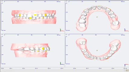 Clearfix Tedavi Simülasyonu - Diastema (Dişler Arası Boşluk)