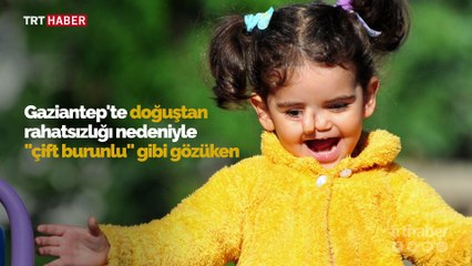 Çift burunlu Öykü'nün tek isteği sağlığına kavuşmak