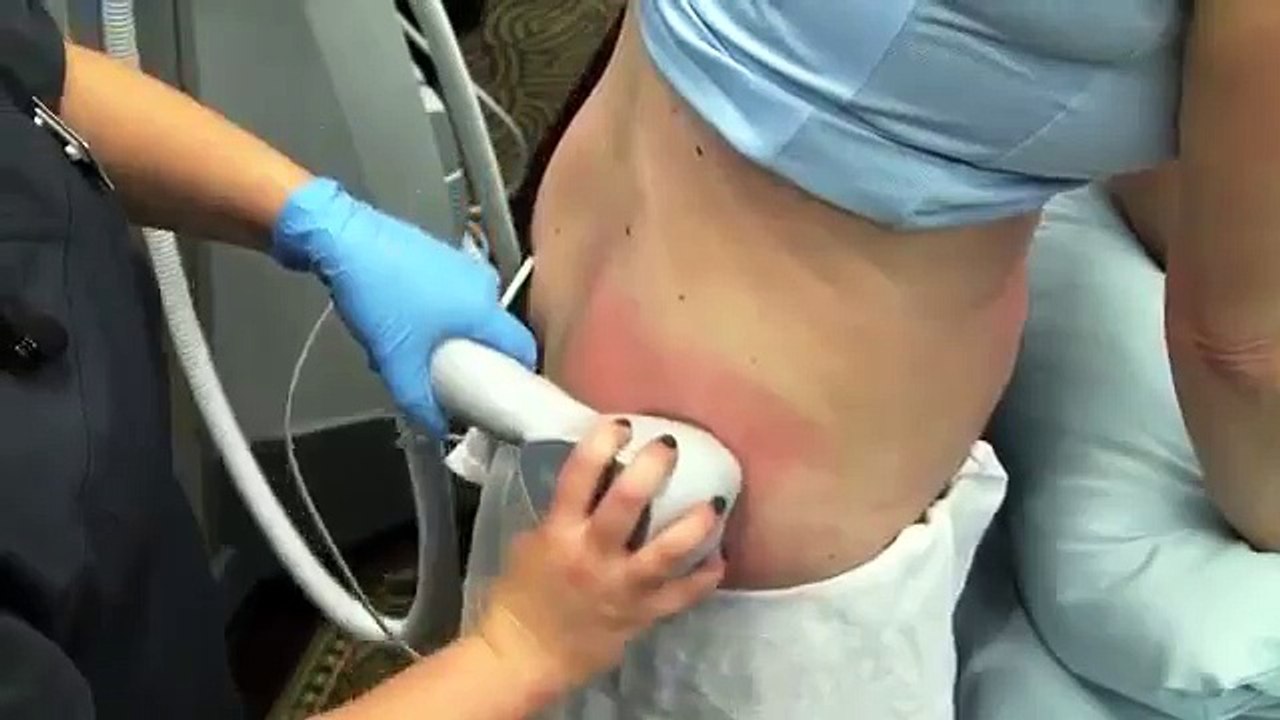 Body Contouring and Tightening with Exilis Elite Technology